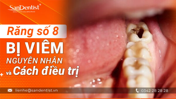 Răng số 8 bị viêm - Nguyên nhân và cách điều trị