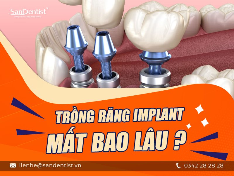 Trồng răng implant mất bao lâu? 