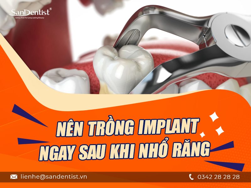 Trồng răng implant mất bao lâu? 