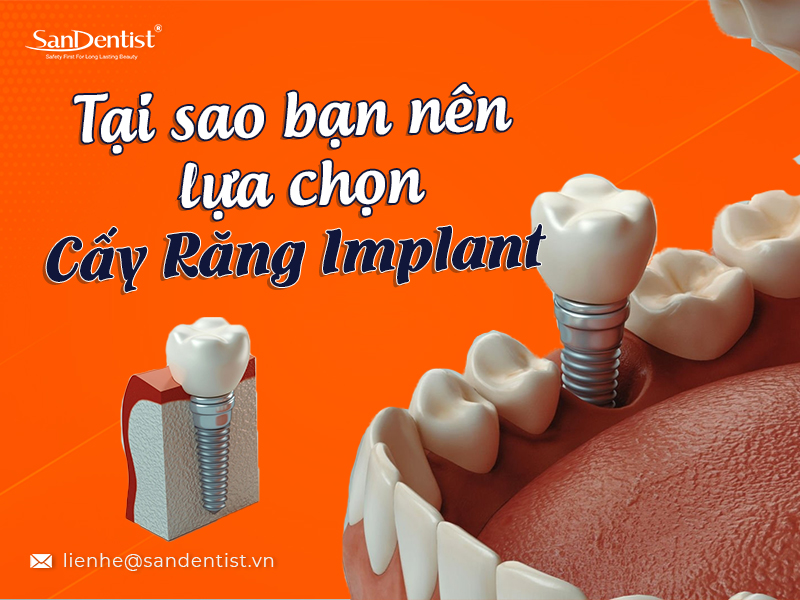 Cấy răng implant giá bao nhiêu? Lý do vì sao bạn nên lựa chọn San Dentist