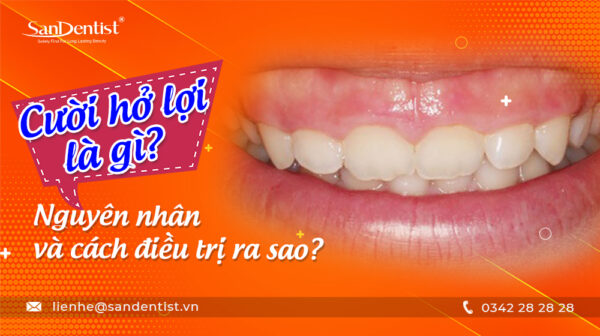 Cười hở lợi là gì? Nguyên nhân và cách điều trị ra sao?