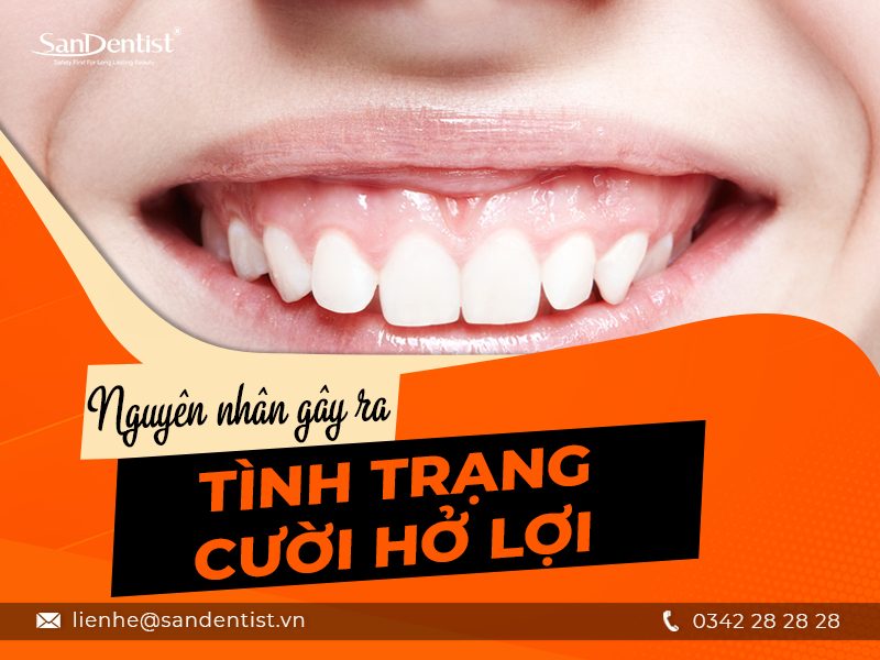 Cười hở lợi và cách khắc phục cực hiệu quả tại San Dentist