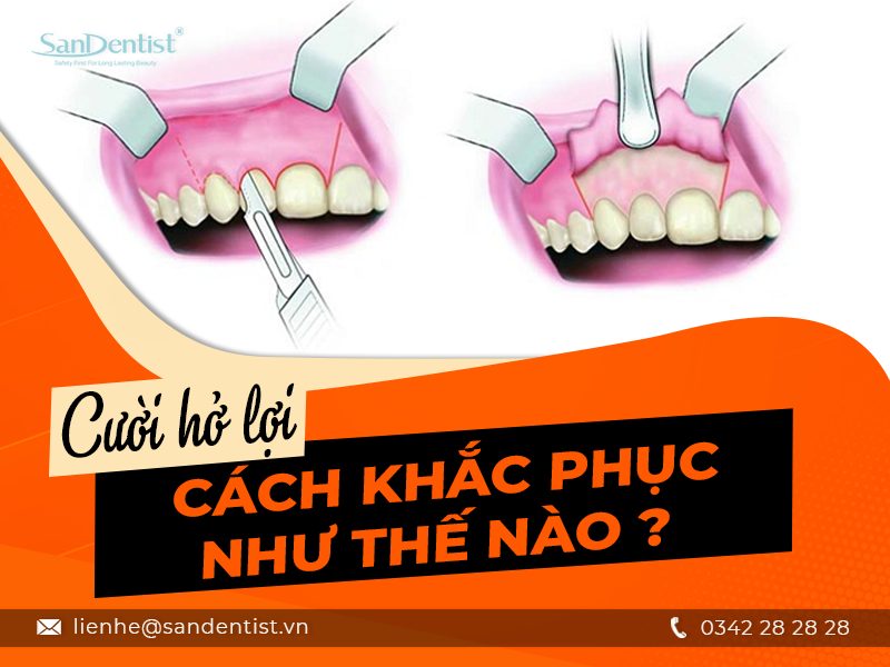 Cười hở lợi và cách khắc phục cực hiệu quả tại San Dentist