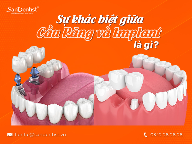Nên làm cầu răng hay Implant sẽ tốt hơn?