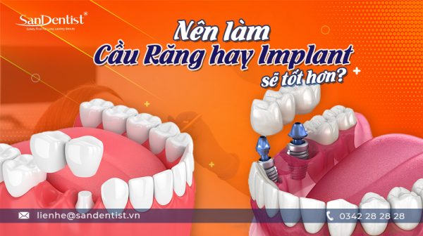 Nên làm cầu răng hay Implant sẽ tốt hơn?