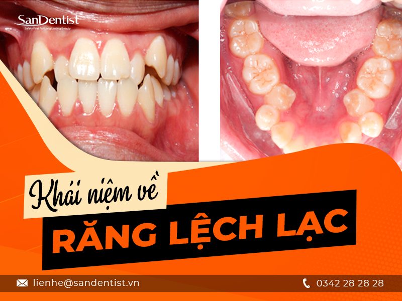 Những thông tin hữu ích về bọc răng sứ cho răng lệch lạc