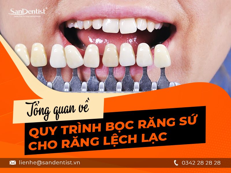 Những thông tin hữu ích về bọc răng sứ cho răng lệch lạc