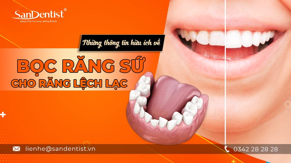 Những thông tin hữu ích về bọc răng sứ cho răng lệch lạc