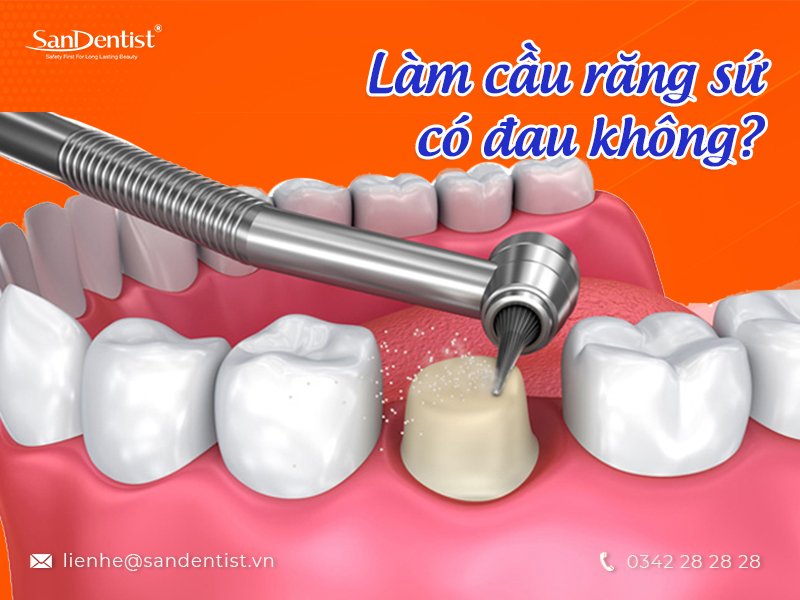 Phương pháp làm cầu răng có đau không? Cách khắc phục như thế nào?