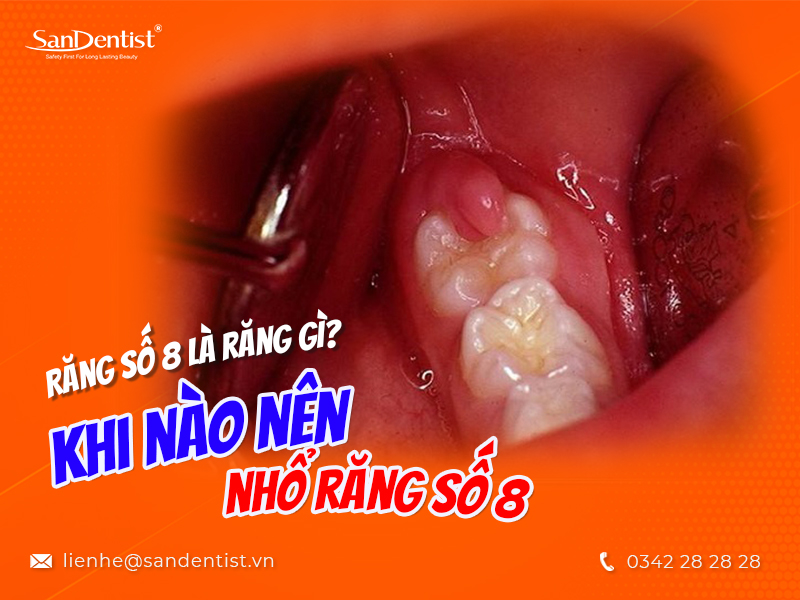 Răng số 8 là răng gì? Có gây biến chứng gì sau khi mổ?