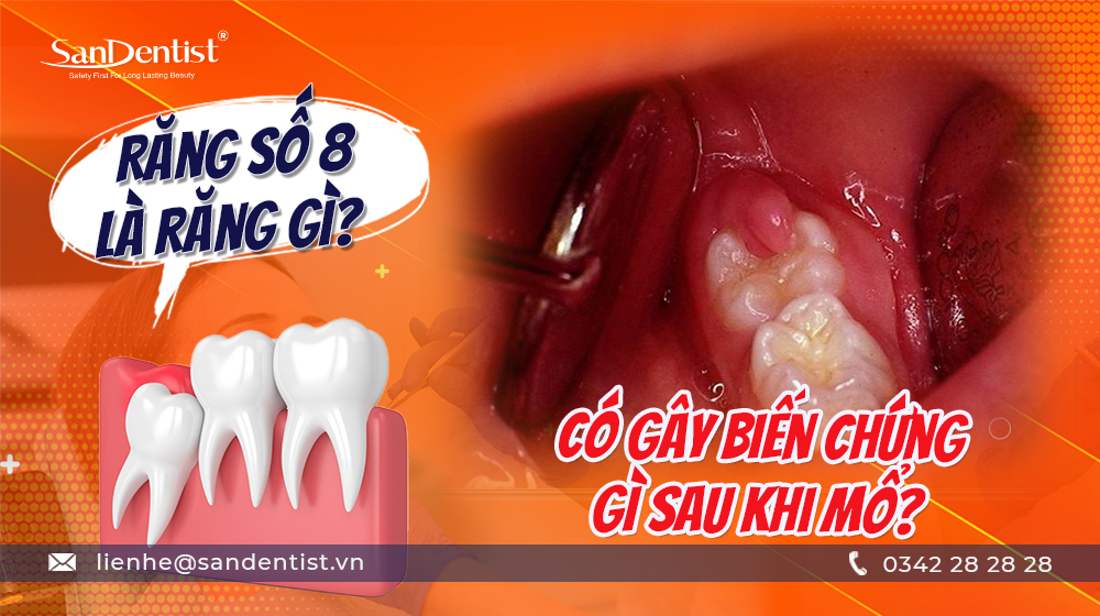Răng số 8 là răng gì? Có gây biến chứng gì sau khi mổ?