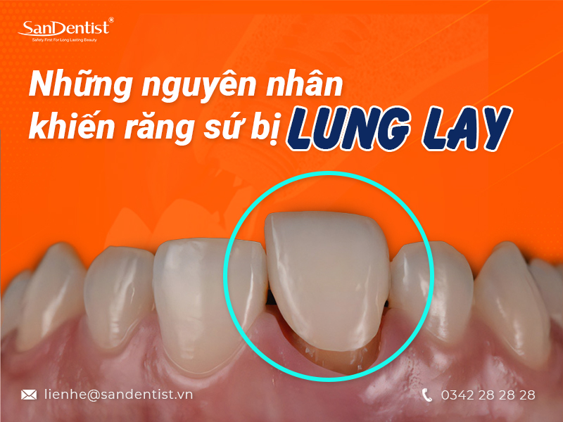 Răng sứ bị lung lay phải làm sao trong quá trình sử dụng?