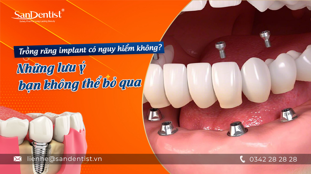 Trồng răng implant có nguy hiểm không? Những lưu ý bạn không thể bỏ qua