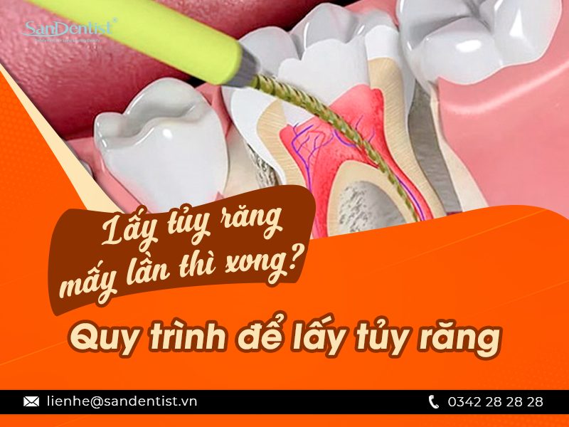  Lấy tủy răng mấy lần mới xong? Quy trình lấy tủy răng như thế nào?