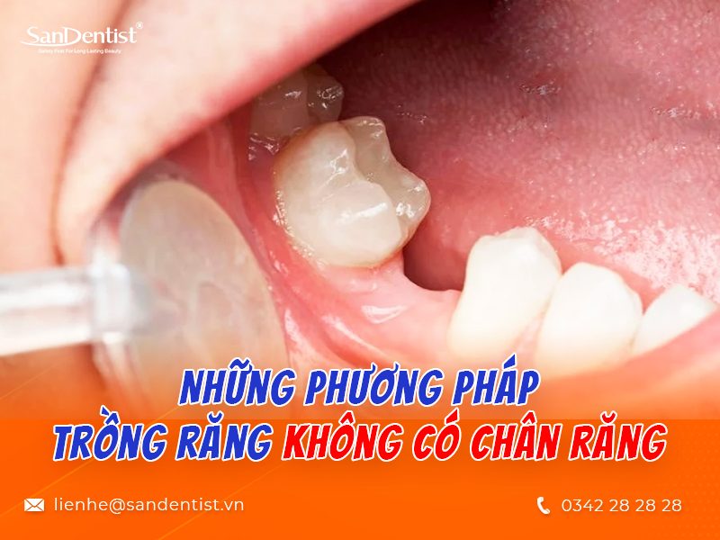 Trồng răng sứ không có chân răng có thật sự tốt? Những sự thật mà bạn cần biết