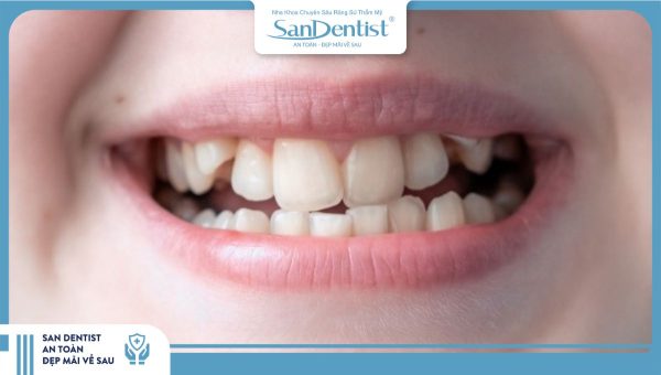 Răng khấp khểnh có bọc sứ được không