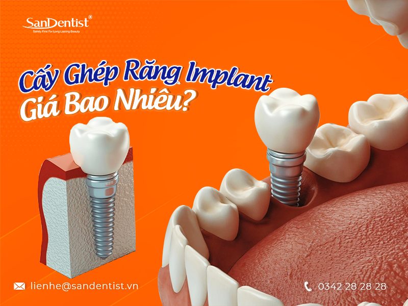 Bảng giá cấy ghép răng implant tại nha khoa San Dentist
