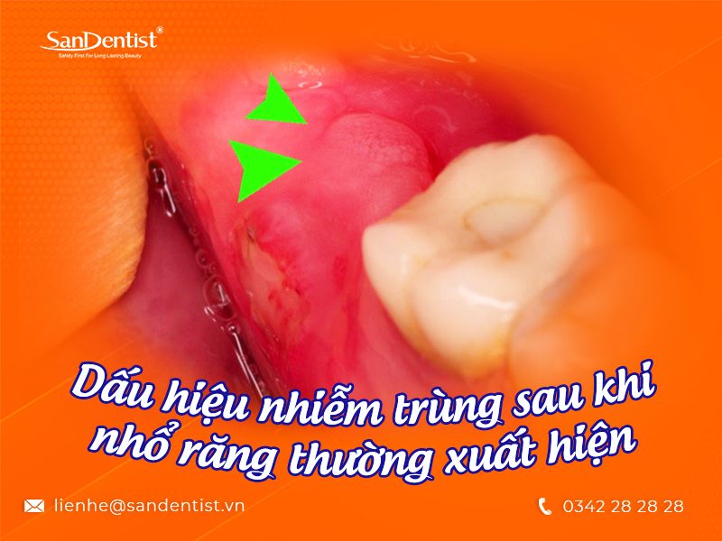 Nhận biết các dấu hiệu nhiễm trùng sau khi nhổ răng khôn