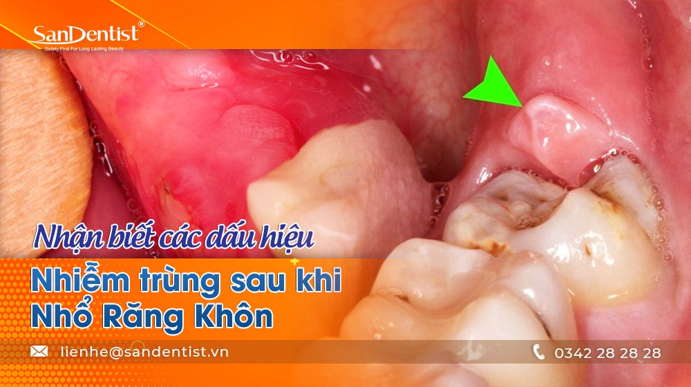 Nhận biết các dấu hiệu nhiễm trùng sau khi nhổ răng khôn