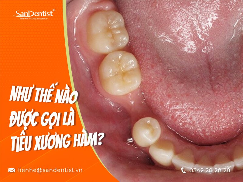 Mất răng bao lâu thì bị tiêu xương hàm? Những nguy hiểm mà người bệnh cần đối mặt khi bị tiêu xương hàm