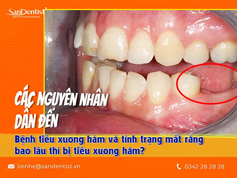 Mất răng bao lâu thì bị tiêu xương hàm? Những nguy hiểm mà người bệnh cần đối mặt khi bị tiêu xương hàm