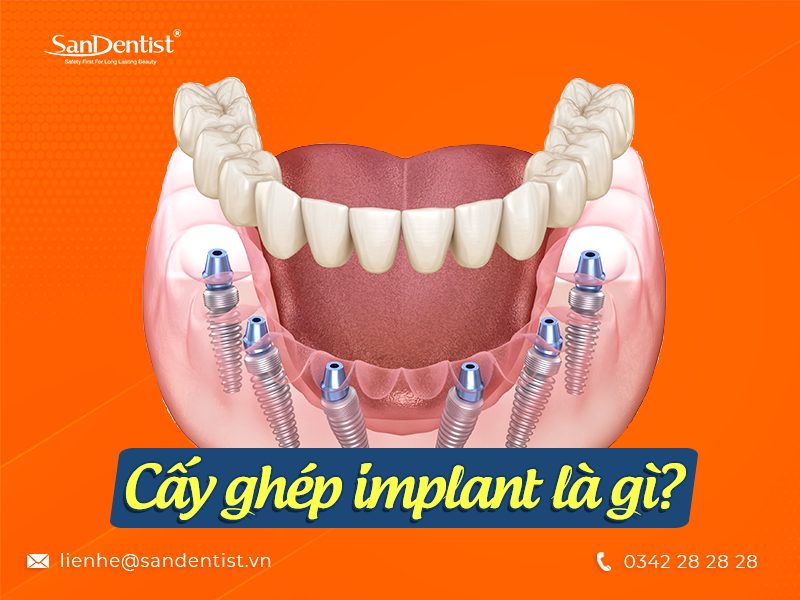 Các bước để thực hiện quy trình cấy ghép implant