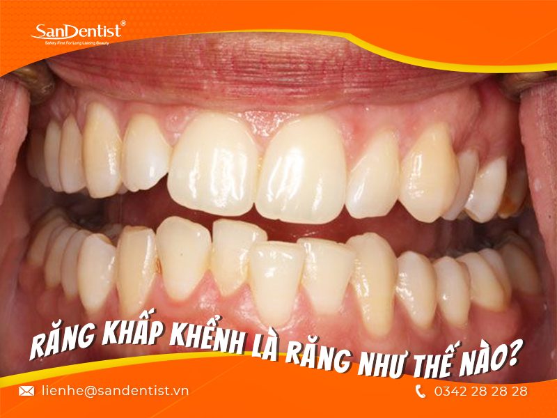 Răng khấp khểnh phải làm sao để hồi phục nhanh chóng