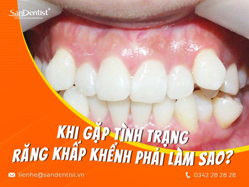 Răng khấp khểnh phải làm sao để hồi phục nhanh chóng