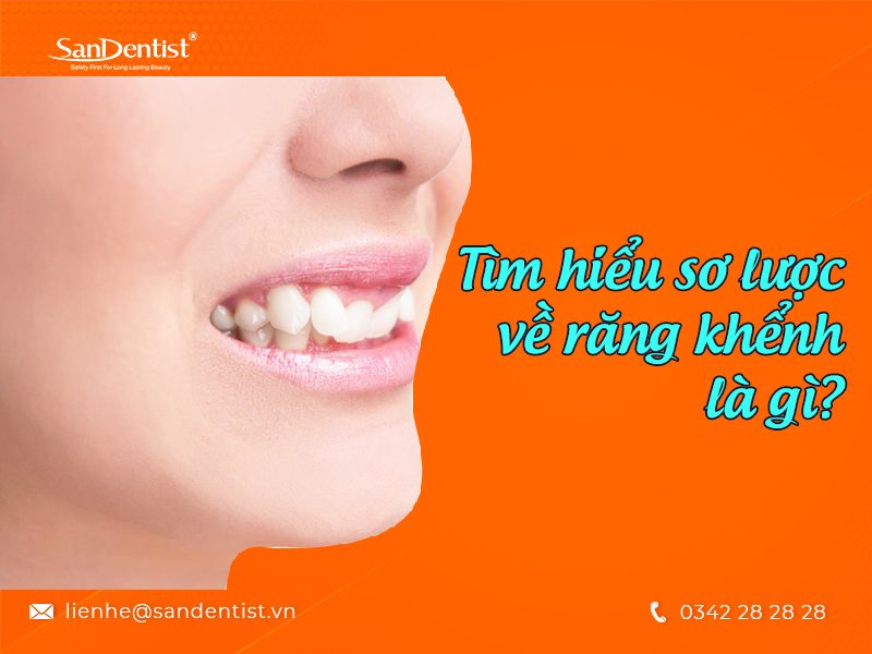 Răng khểnh là gì? Và những sự thật thú vị về răng khểnh