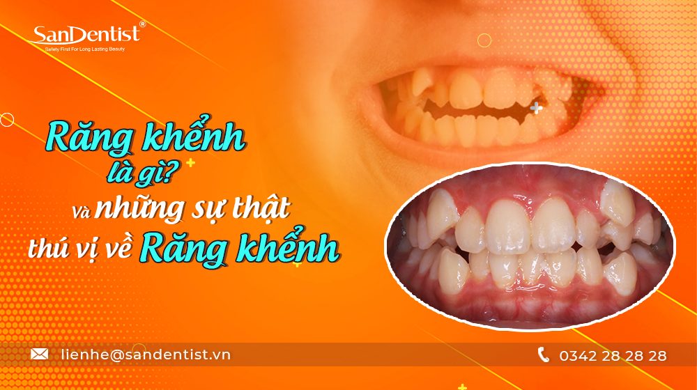 Răng khểnh là gì? Và những sự thật thú vị về răng khểnh