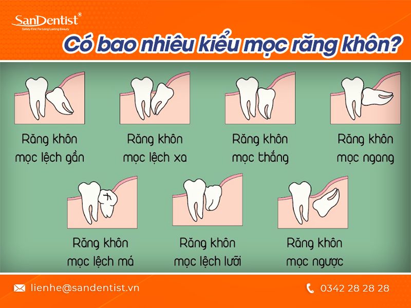 Răng số 8 là răng gì? Răng số 8 gây ra các biến chứng nào?