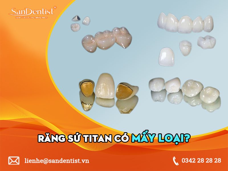 Răng sứ titan có mấy loại? Giải đáp những thắc mắc về răng sứ titan