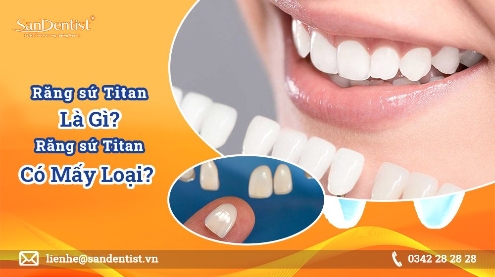 Răng sứ Titan là gì? Răng sứ Titan có mấy loại?