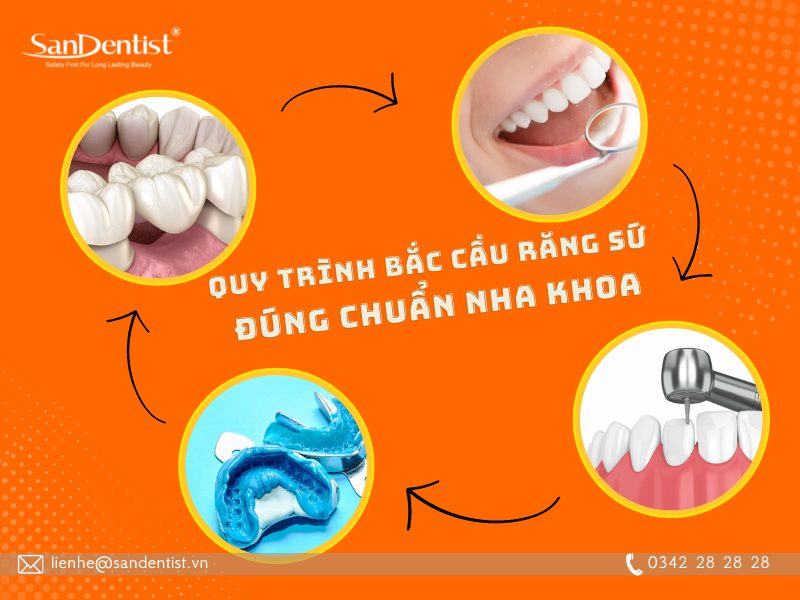 Bắc cầu răng sứ là gì? Ưu điểm và hạn chế của phương pháp này?