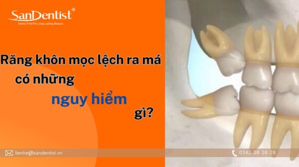 Răng khôn mọc lệch ra má có những nguy hiểm gì?