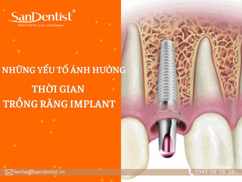 Trồng răng Implant mất bao lâu? Yếu tố ảnh hưởng tới thời gian trồng răng