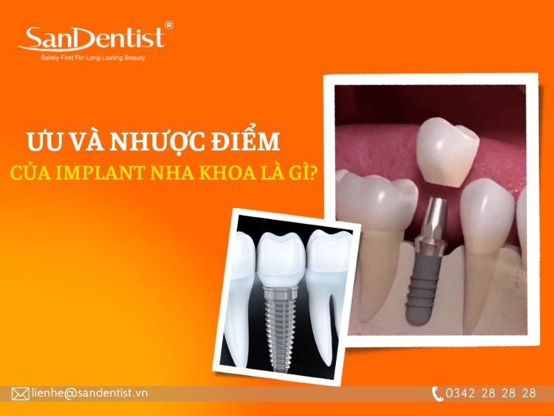 Tìm hiểu cấy ghép Implant nha khoa là gì? Ưu và nhược điểm của phương pháp này