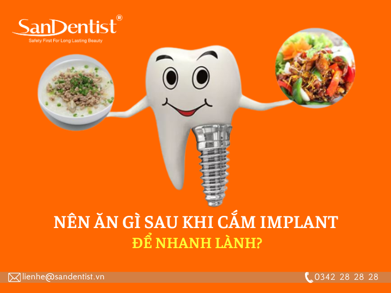 Nên kiêng gì khi cắm răng Implant để tránh các biến chứng?