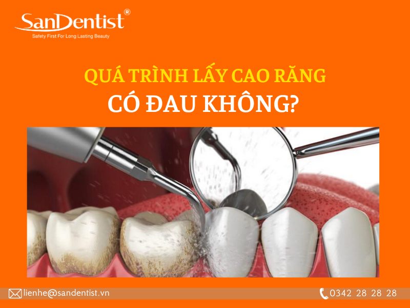 Cao răng là gì? Lấy cao răng có đau không?