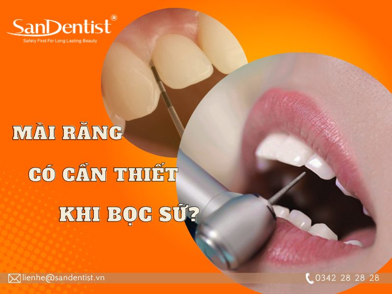 Tìm hiểu mài răng có cần thiết khi bọc sứ hay không?