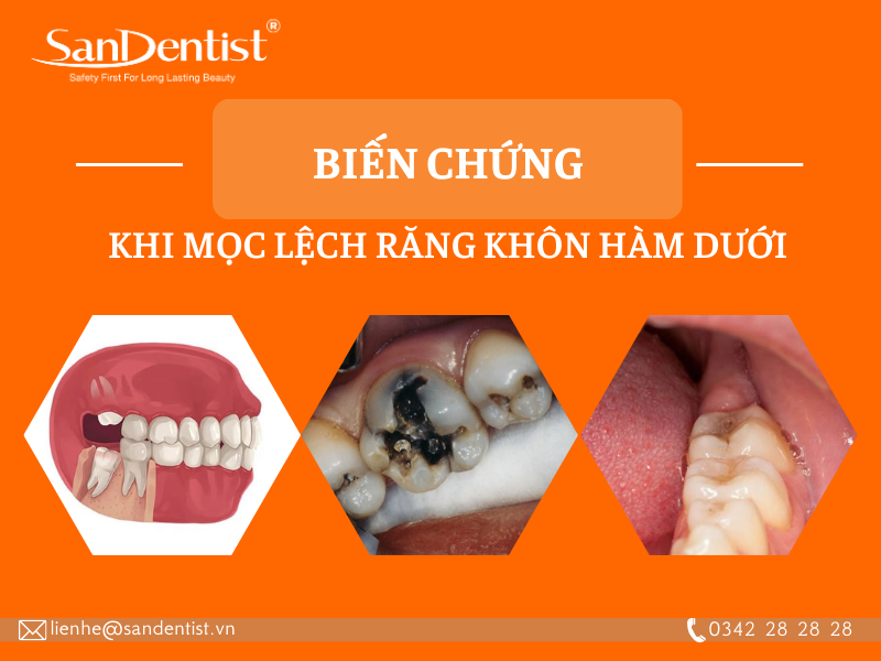 Mọc răng khôn hàm dưới có nên nhổ hay không?