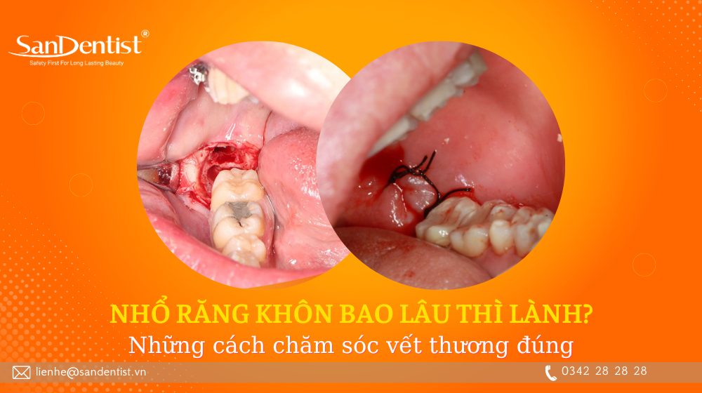 4. Lưu ý sau khi nhổ răng số 8