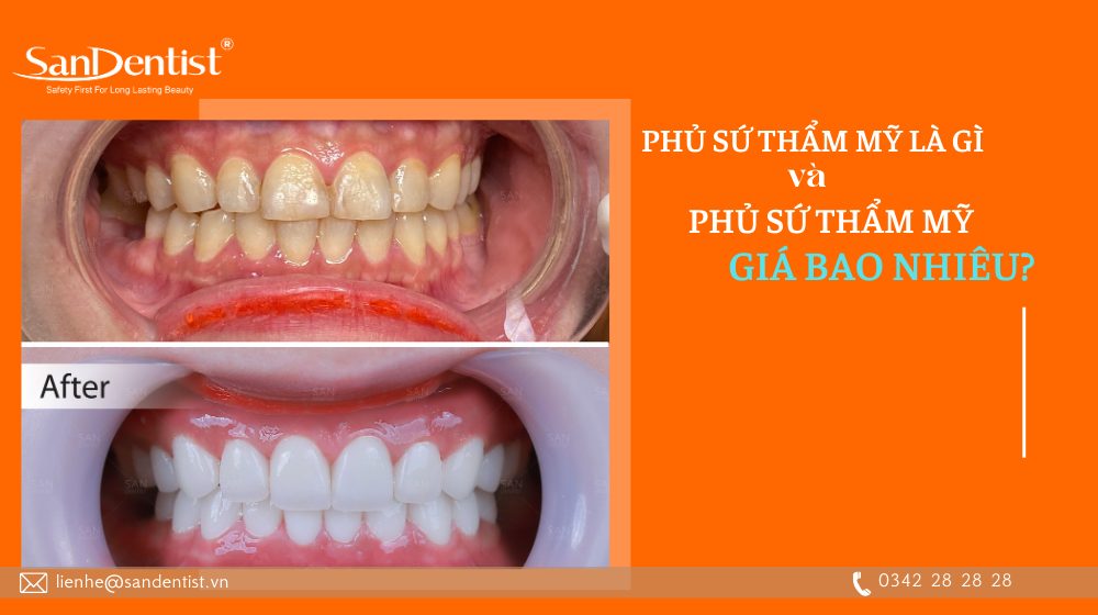 Phủ sứ thẩm mỹ là gì và phủ sứ thẩm mỹ giá bao nhiêu? 