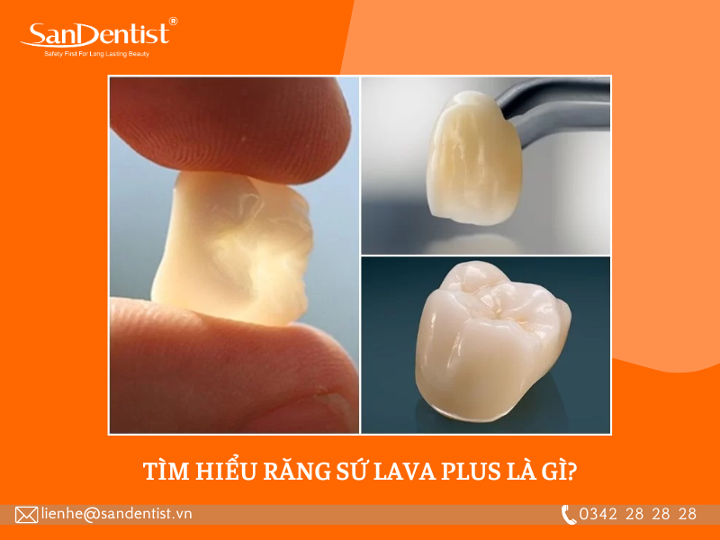 Răng sứ Lava Plus là gì? Những ưu điểm của loại răng sứ này?