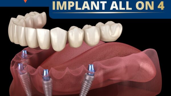 Những yếu tố quyết định giá trồng răng implant