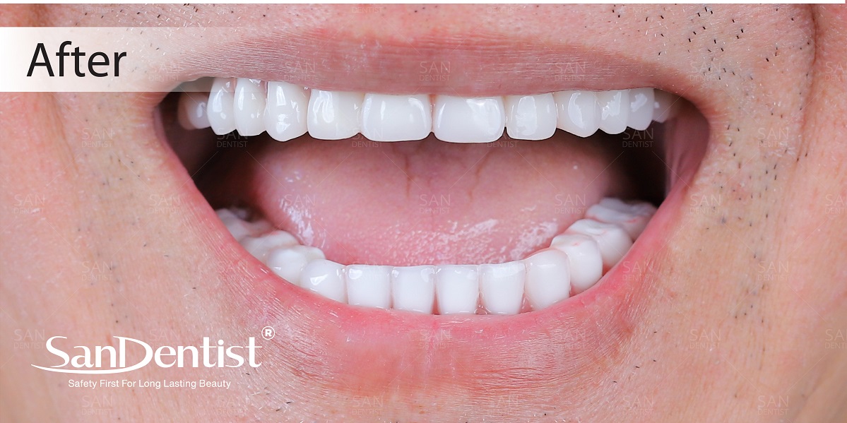 Trì hoãn cấy ghép Implant sẽ gây ra hậu quả gì?