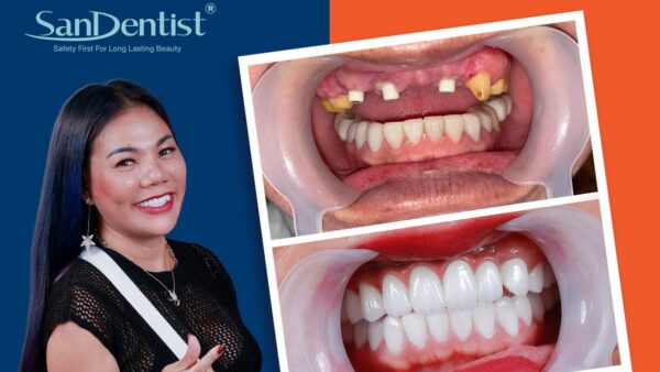 Khám phá nghệ thuật trồng răng qua phương pháp cấy ghép Implant