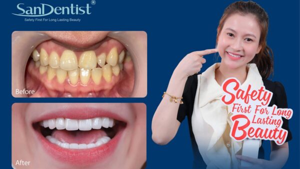 Phủ răng sứ: Sự kết hợp của nghệ thuật và nha khoa thẩm mỹ