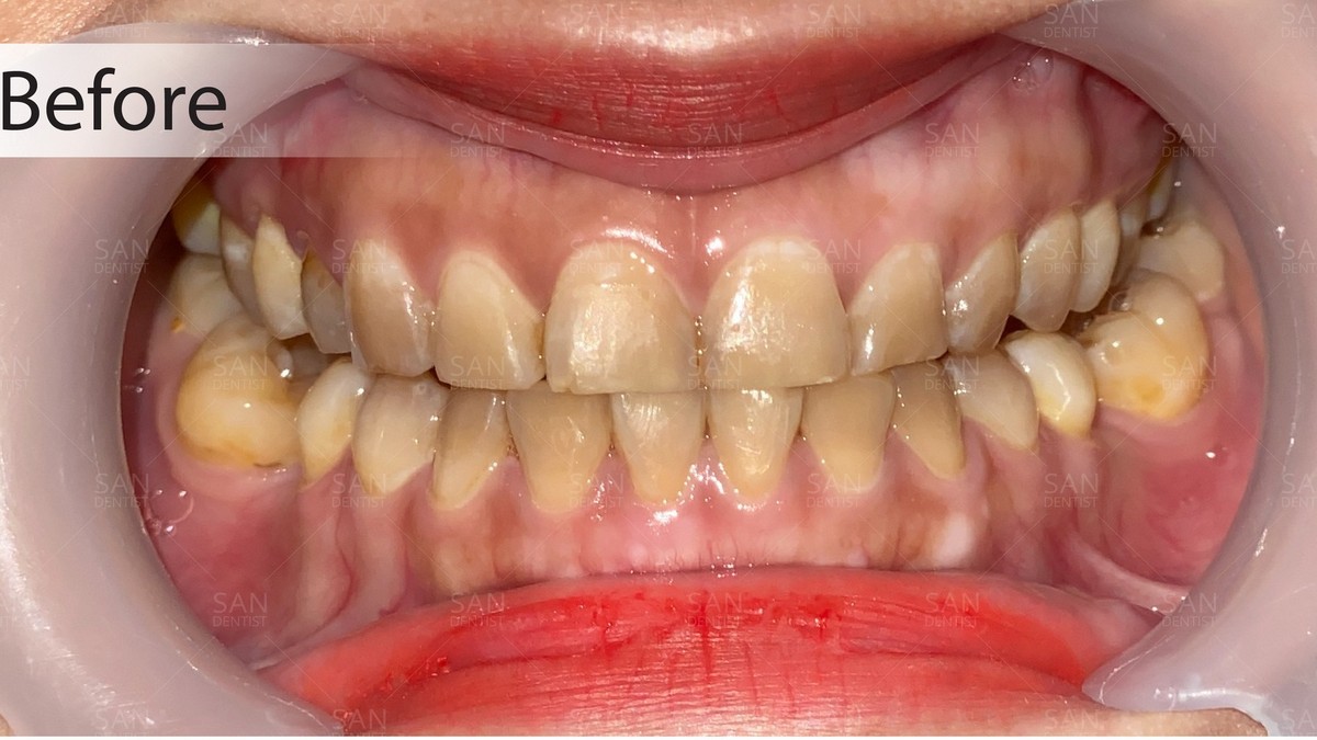 Hàm răng ố vàng: Nguyên nhân do 7 thói quen xấu này!