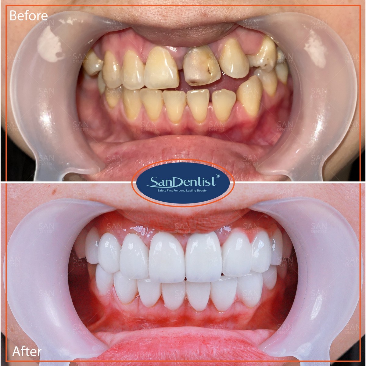 Răng thưa: Nguyên nhân gây ra và những cách xử lý